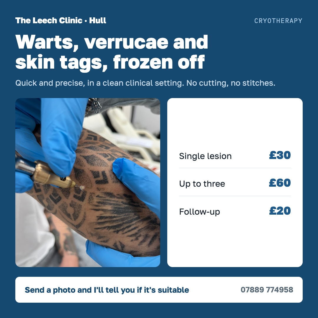 Warts, verrucae and skin tags, frozen off — no cutting.