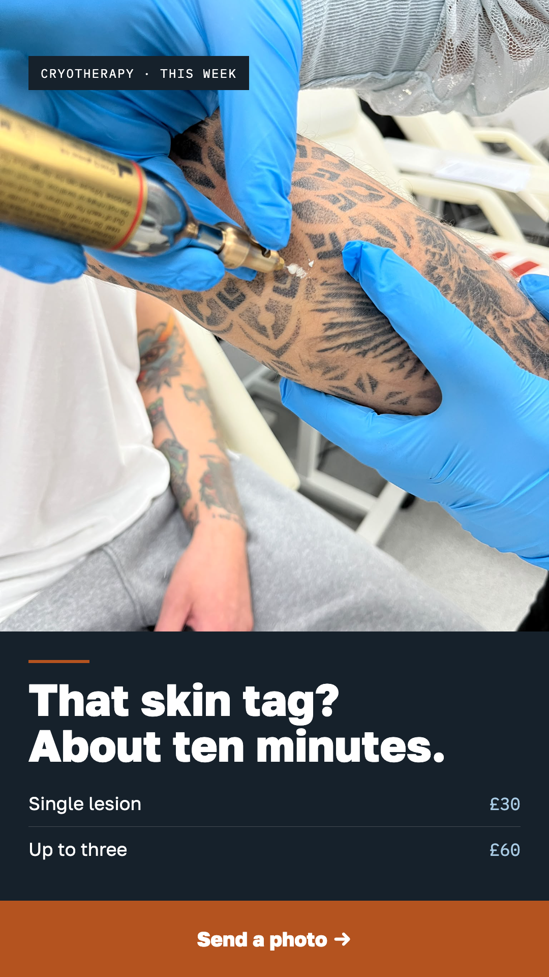 That skin tag? About ten minutes.